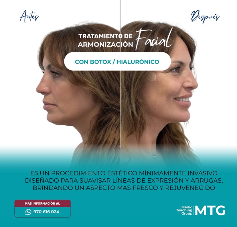 Close up of a facial harmonization procedure with injectables.