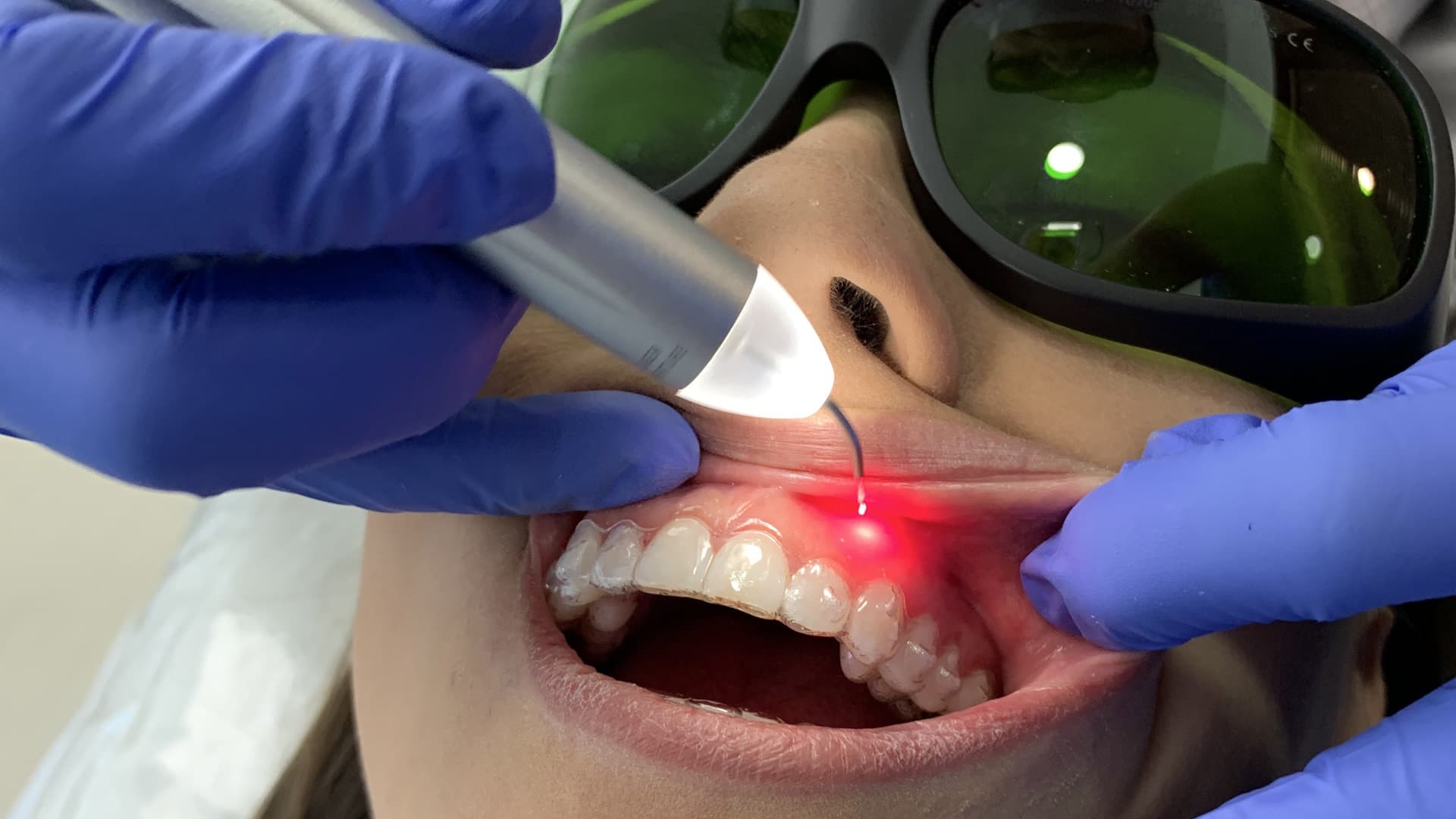 Dentist performing a laser procedure on a patient.