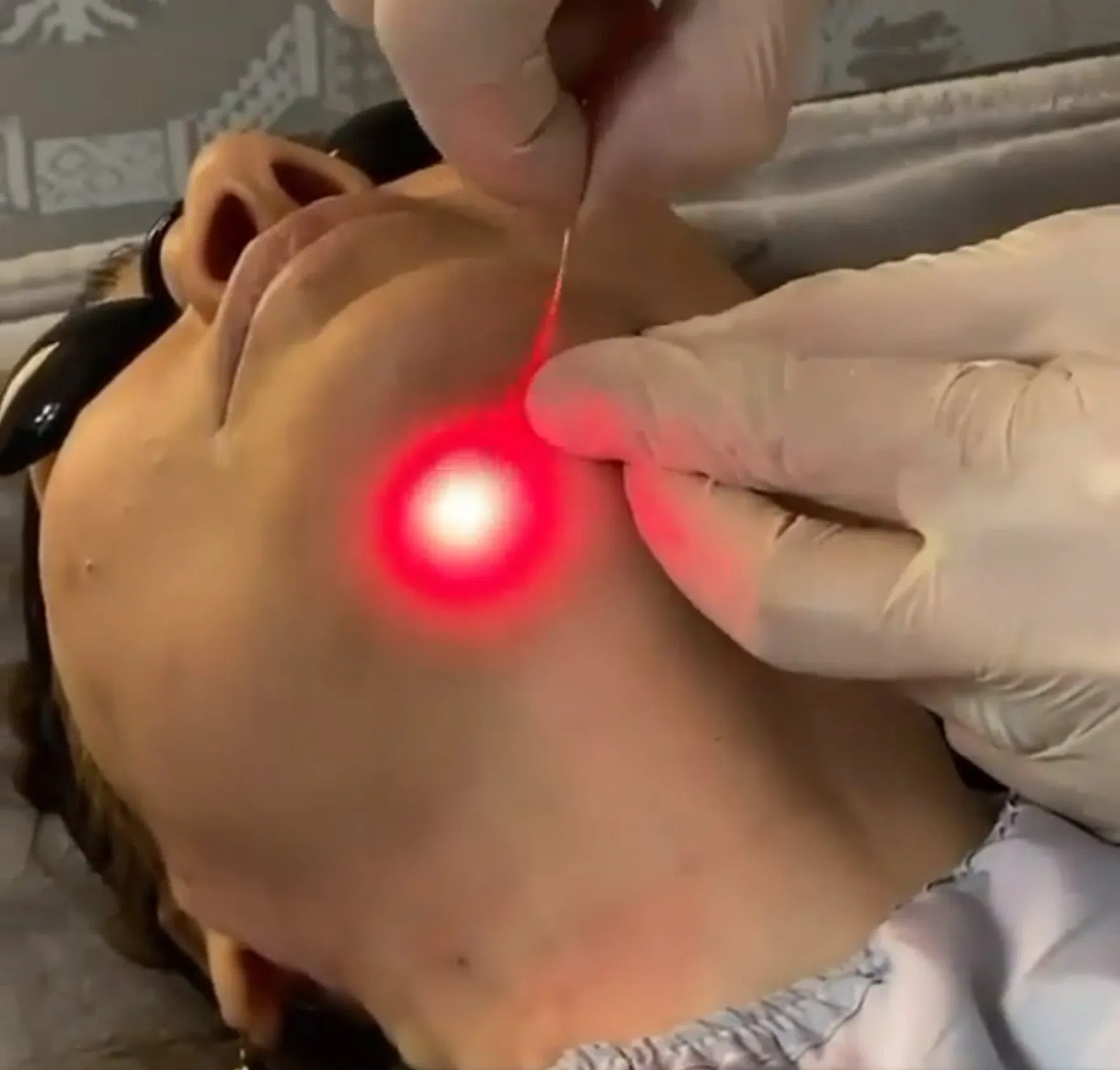 Medical illustration of a herniated disc.