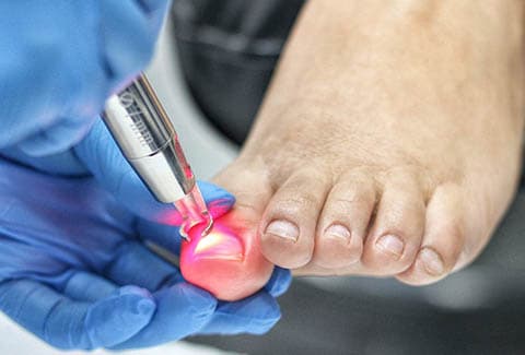 Laser treatment for toenail fungus.